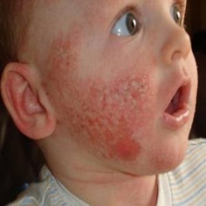 Cures-For-A-Face-Rash
