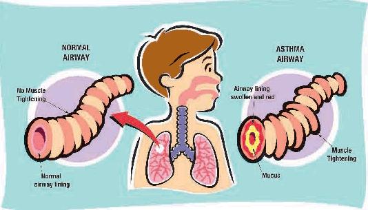 child-asthma-print-version-